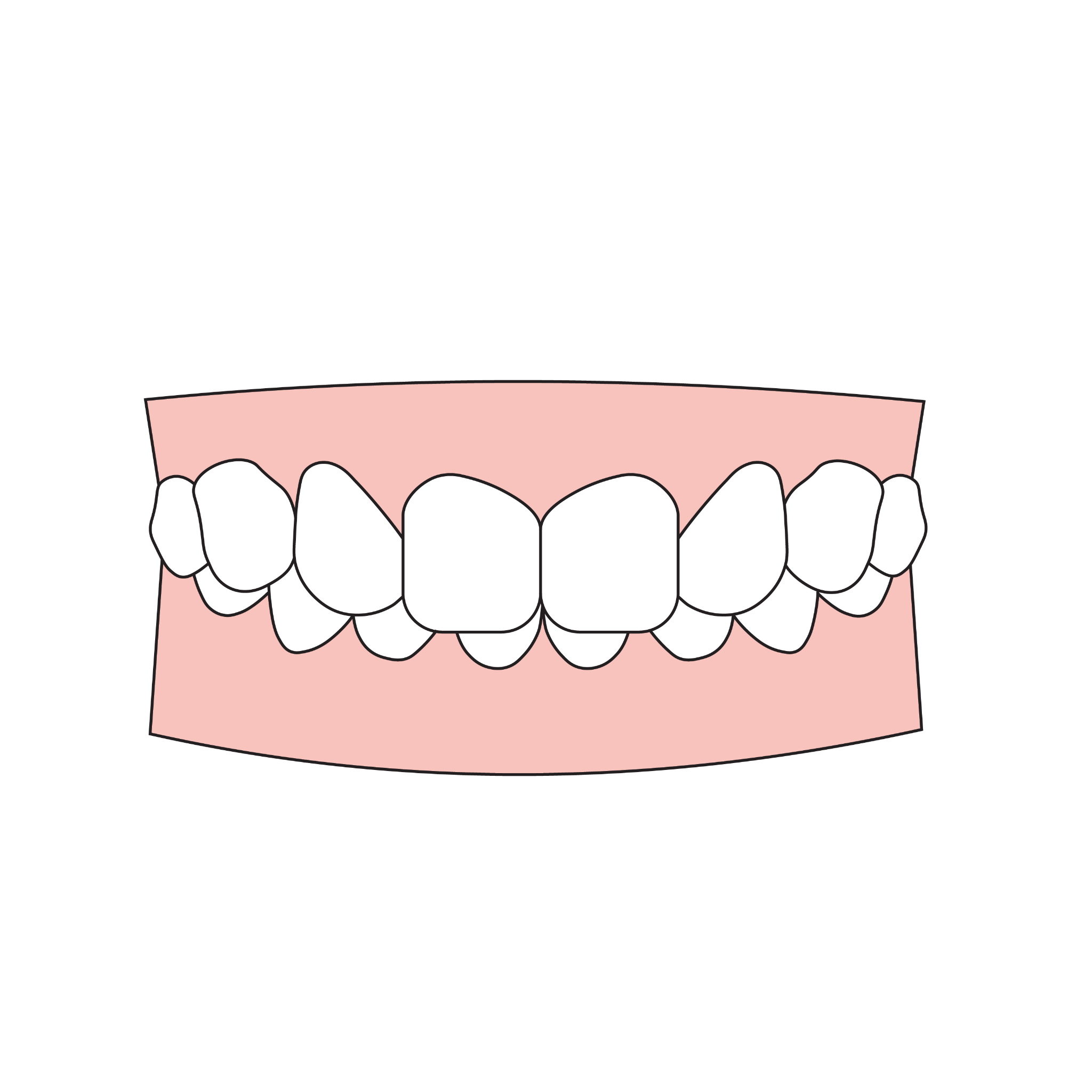 Overbite